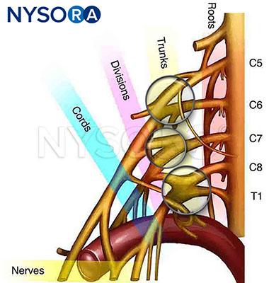 Regional Techniques to the Brachial Plexus - Derek & Lester